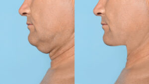 Kybella for Double Chin Reduction Bellaire Dermatology